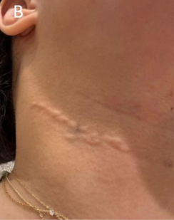 목주름필러 부작용, 울퉁불퉁함이 붓기인지 과교정인지 구분하는 기준